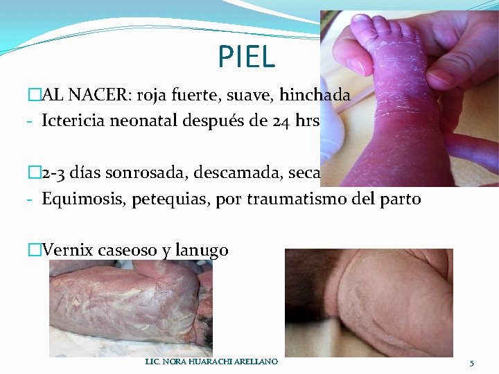 PIEL �AL NACER: roja fuerte, suave, hinchada - Ictericia neonatal después de 24 hrs