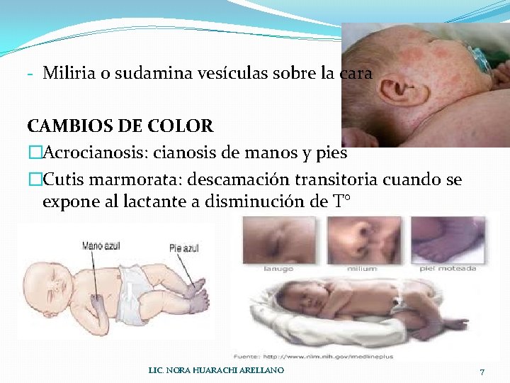 - Miliria o sudamina vesículas sobre la cara CAMBIOS DE COLOR �Acrocianosis: cianosis de