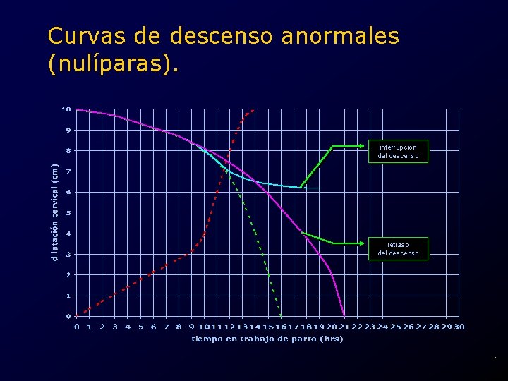 Curvas de descenso anormales (nulíparas). interrupción del descenso retraso del descenso . 