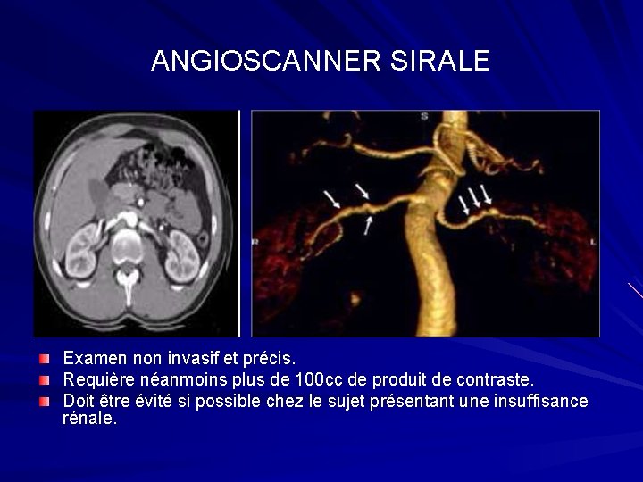 ANGIOSCANNER SIRALE Examen non invasif et précis. Requière néanmoins plus de 100 cc de