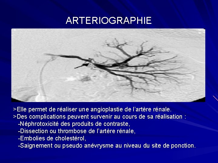 ARTERIOGRAPHIE >Elle permet de réaliser une angioplastie de l’artère rénale. >Des complications peuvent survenir