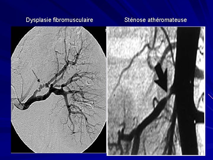 Dysplasie fibromusculaire Sténose athéromateuse 