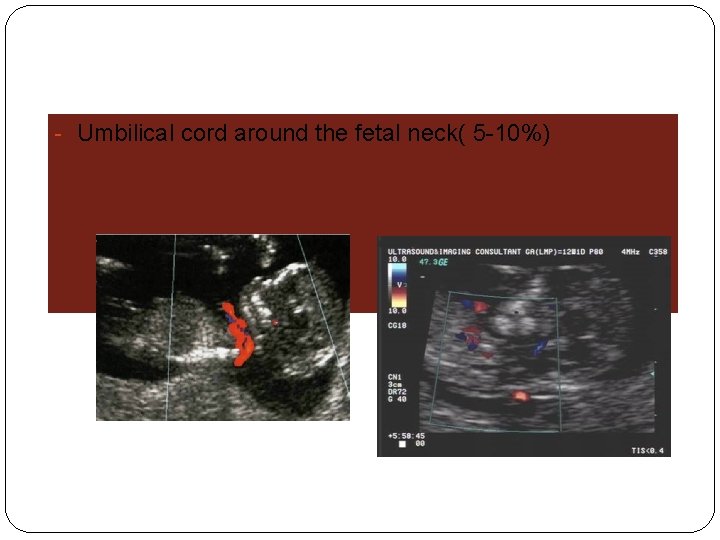 - Umbilical cord around the fetal neck( 5 -10%) 
