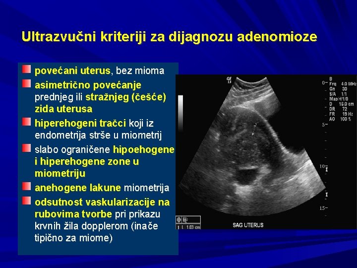 Ultrazvučni kriteriji za dijagnozu adenomioze povećani uterus, bez mioma asimetrično povećanje prednjeg ili stražnjeg
