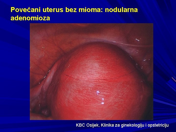 Povećani uterus bez mioma: nodularna adenomioza KBC Osijek, Klinika za ginekologiju i opstetriciju 