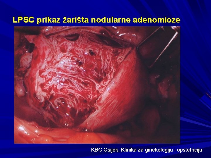 LPSC prikaz žarišta nodularne adenomioze KBC Osijek, Klinika za ginekologiju i opstetriciju 