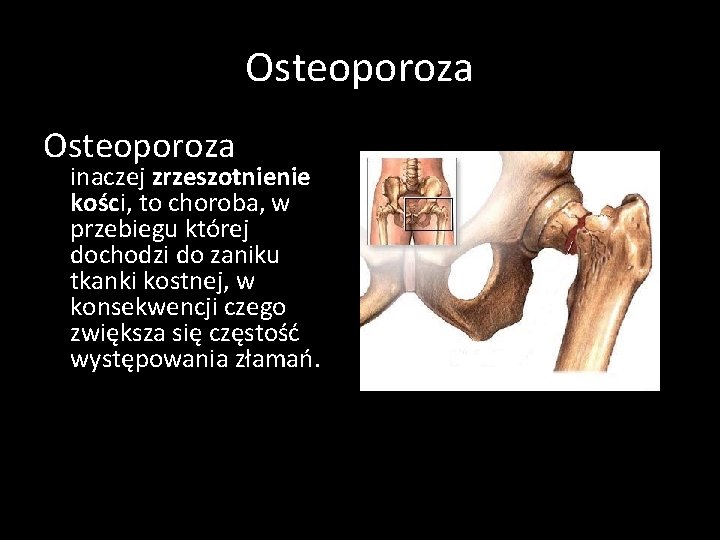 Osteoporoza inaczej zrzeszotnienie kości, to choroba, w przebiegu której dochodzi do zaniku tkanki kostnej,