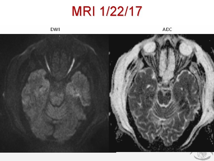 MRI 1/22/17 DWI ADC 