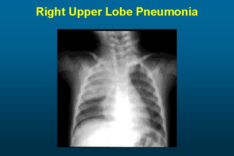 Right Upper Lobe Pneumonia 