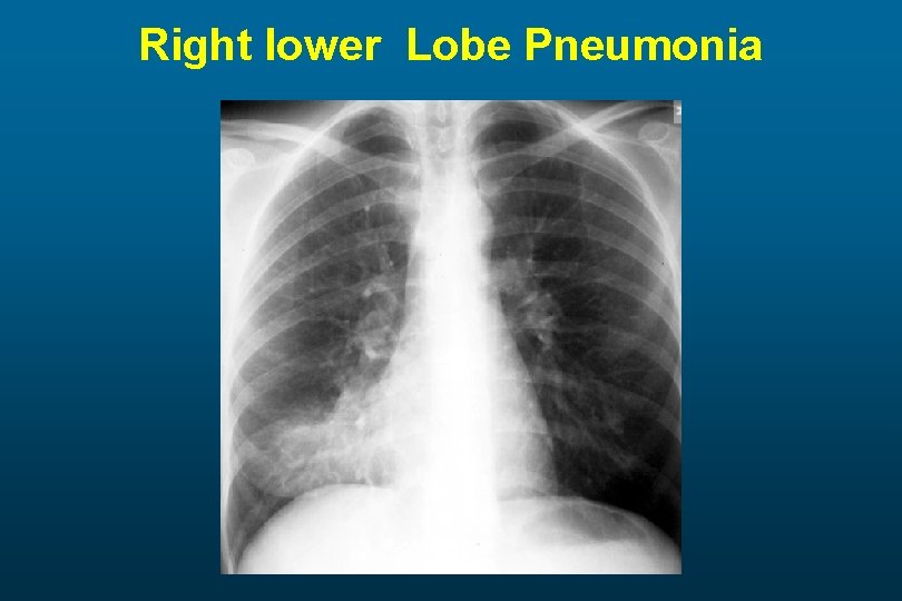 Right lower Lobe Pneumonia 