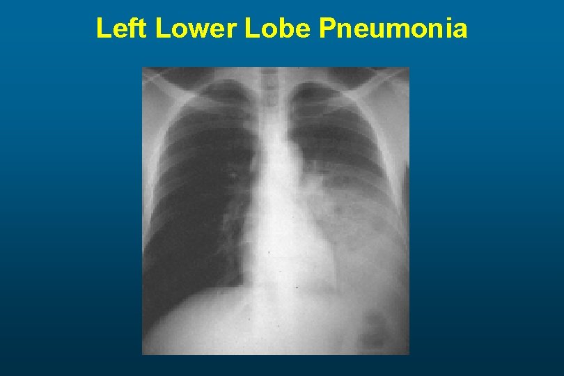 Left Lower Lobe Pneumonia 