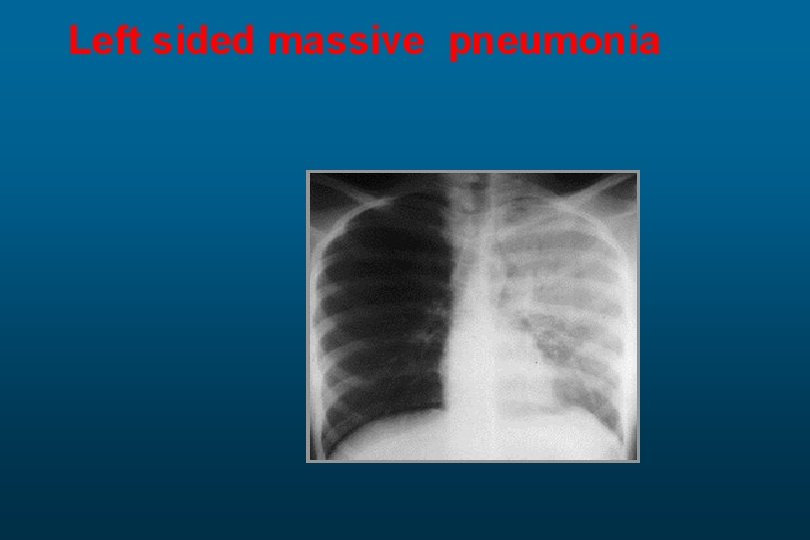 Left sided massive pneumonia 