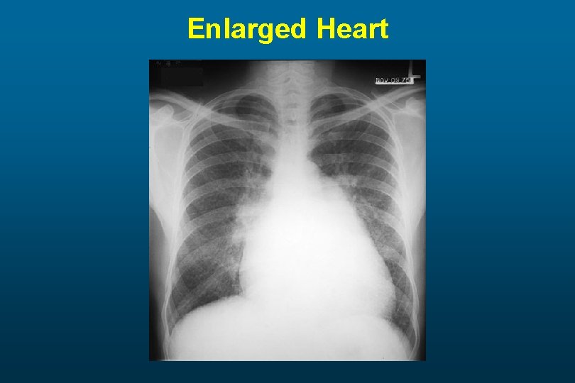 Enlarged Heart 