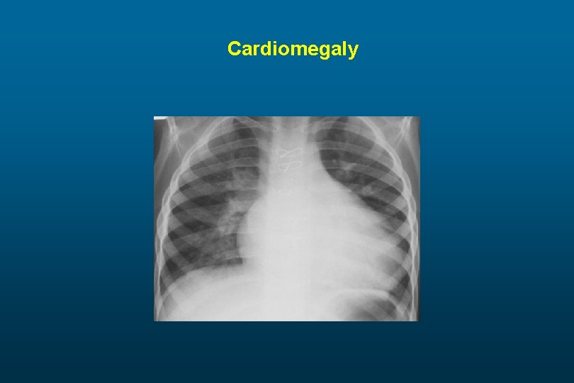 Cardiomegaly 