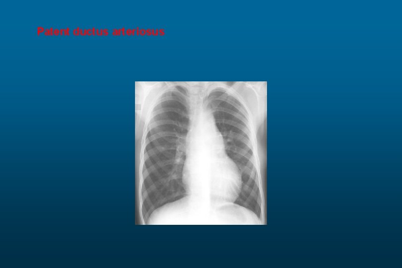 Patent ductus arteriosus 