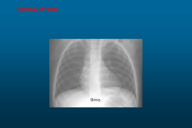 Tetralogy of Fallot, 