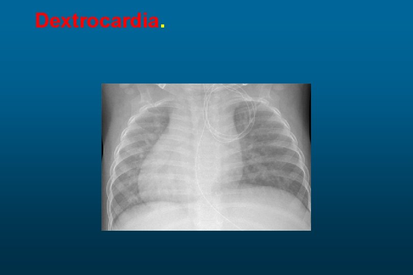 Dextrocardia. 