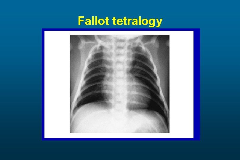 Fallot tetralogy 