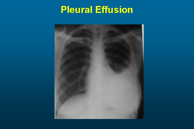 Pleural Effusion 