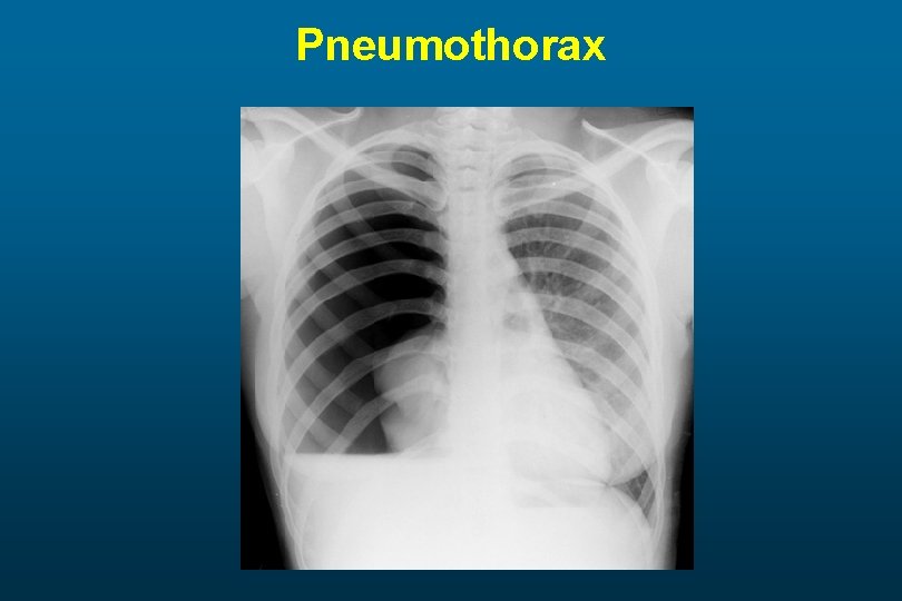 Pneumothorax 