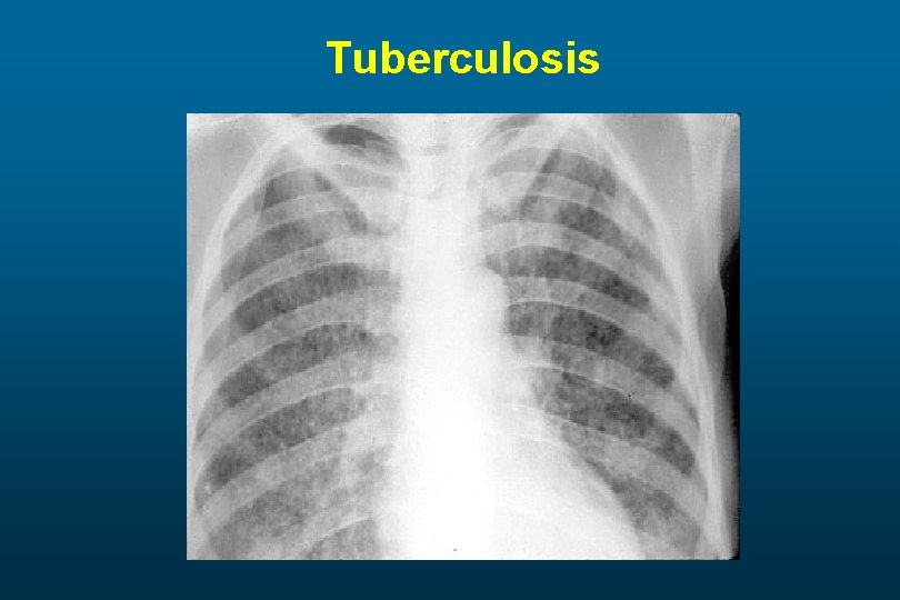 Tuberculosis 