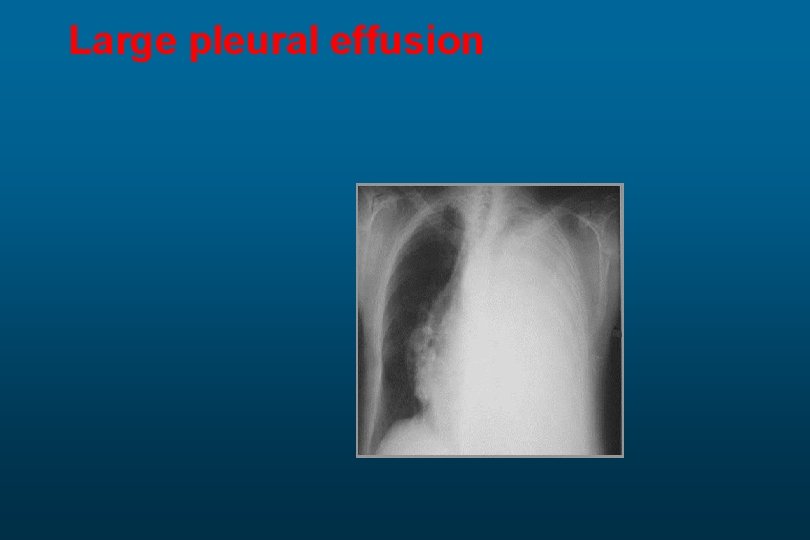 Large pleural effusion 