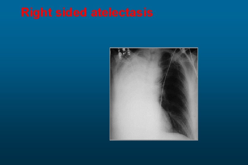 Right sided atelectasis 