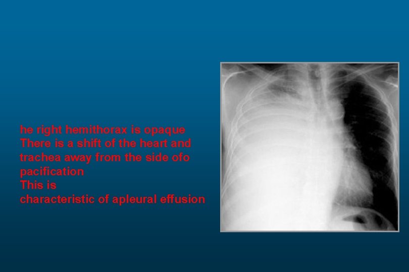 he right hemithorax is opaque There is a shift of the heart and trachea