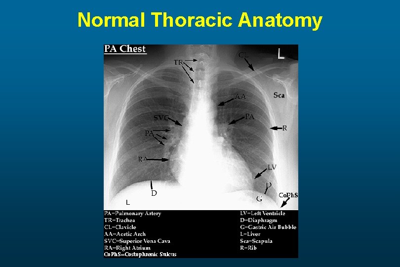 Normal Thoracic Anatomy 