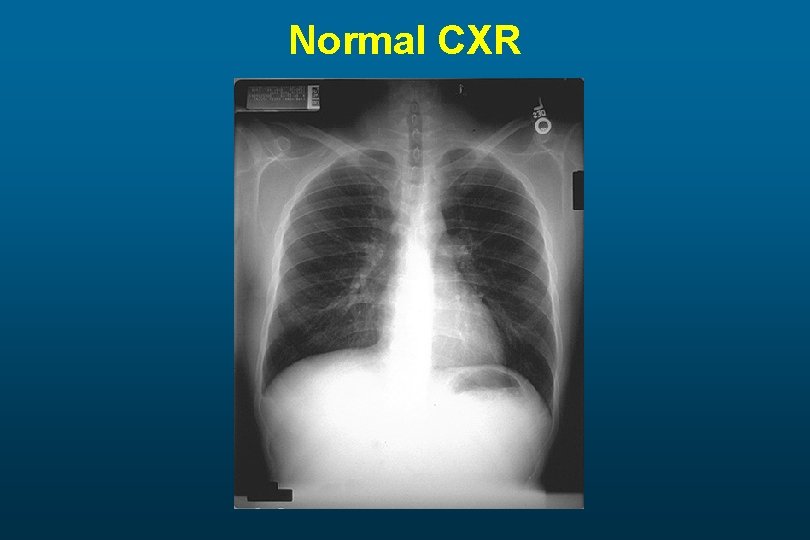 Normal CXR 