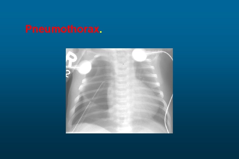 Pneumothorax. 