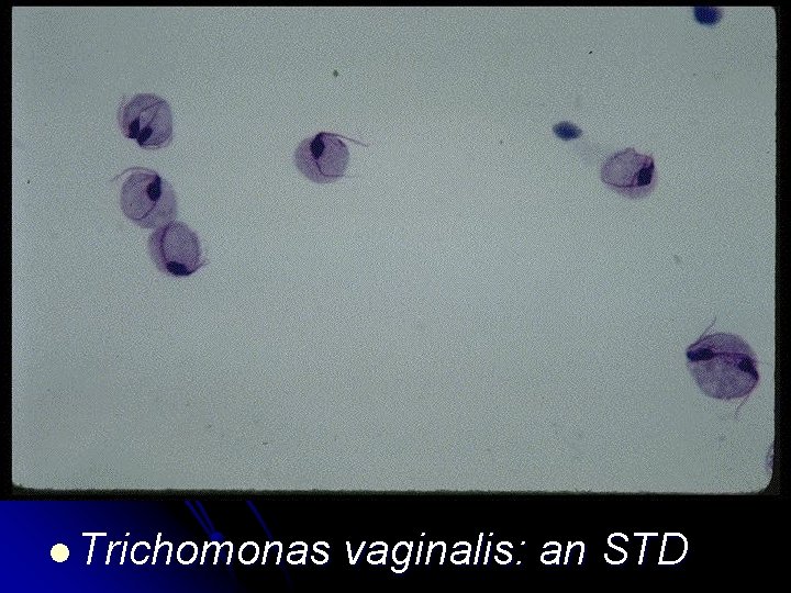 l Trichomonas vaginalis: an STD 