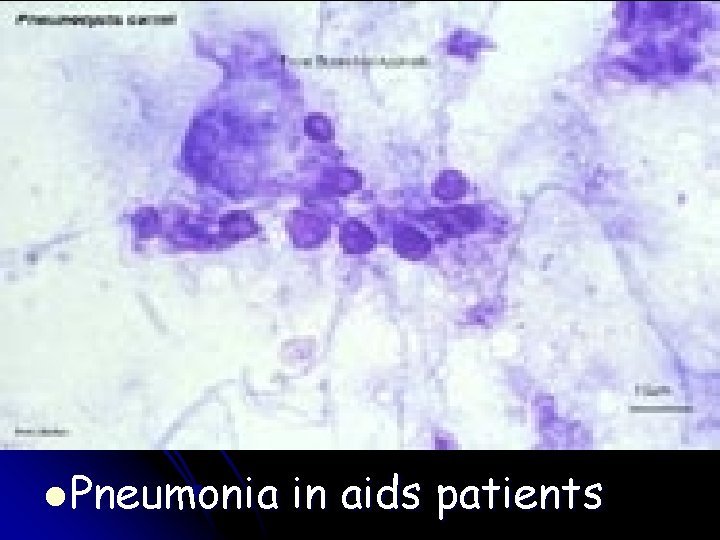 l Pneumonia in aids patients 