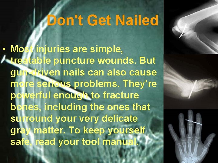 Don't Get Nailed • Most injuries are simple, treatable puncture wounds. But gun-driven nails