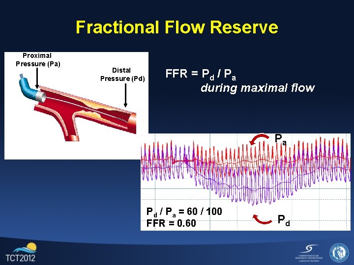Fractional Flow Reserve Proximal Pressure (Pa) Distal Pressure (Pd) FFR = Pd / Pa