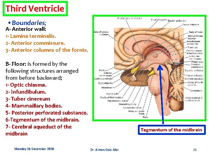 Third Ventricle • Boundaries; A- Anterior wall: 1 - Lamina terminalis. 2 - Anterior