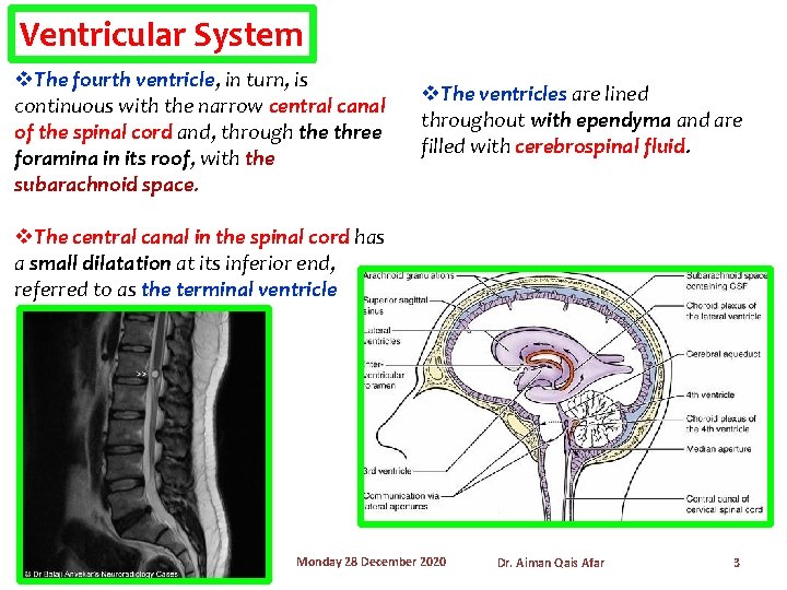 Ventricular System v. The fourth ventricle, in turn, is continuous with the narrow central
