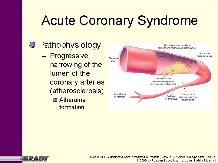 Acute Coronary Syndrome Pathophysiology – Progressive narrowing of the lumen of the coronary arteries Acute Coronary Syndrome Pathophysiology – Progressive narrowing of the lumen of the coronary arteries