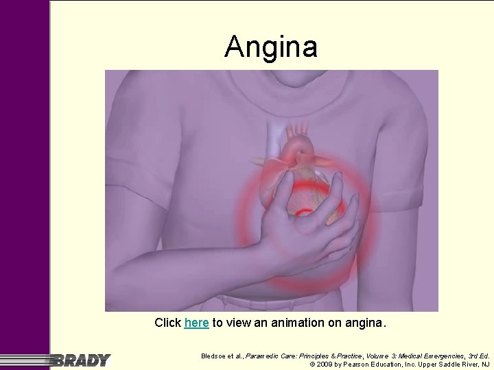 Angina Click here to view an animation on angina. Bledsoe et al. , Paramedic Angina Click here to view an animation on angina. Bledsoe et al. , Paramedic