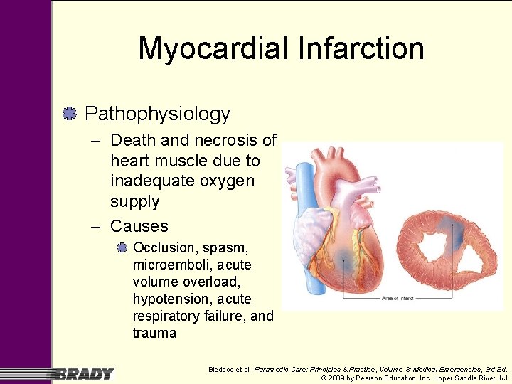 Myocardial Infarction Pathophysiology – Death and necrosis of heart muscle due to inadequate oxygen Myocardial Infarction Pathophysiology – Death and necrosis of heart muscle due to inadequate oxygen