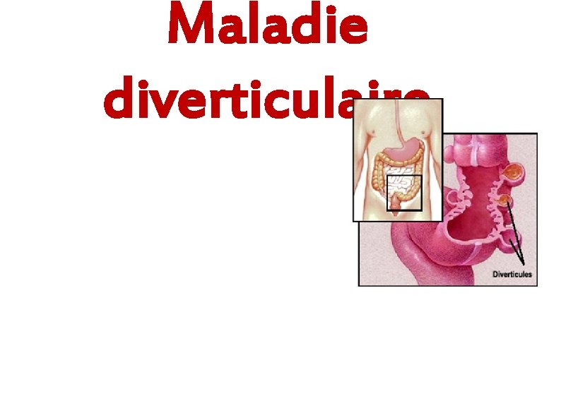 Maladie diverticulaire 