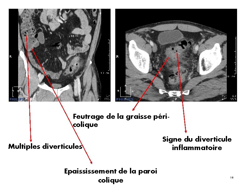 Feutrage de la graisse péricolique Multiples diverticules Epaississement de la paroi colique Signe du