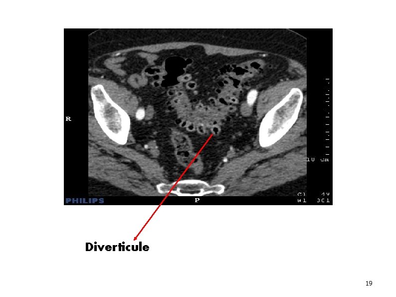 Diverticule 19 