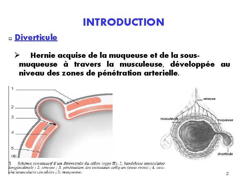 INTRODUCTION Diverticule Hernie acquise de la muqueuse et de la sousmuqueuse à travers la