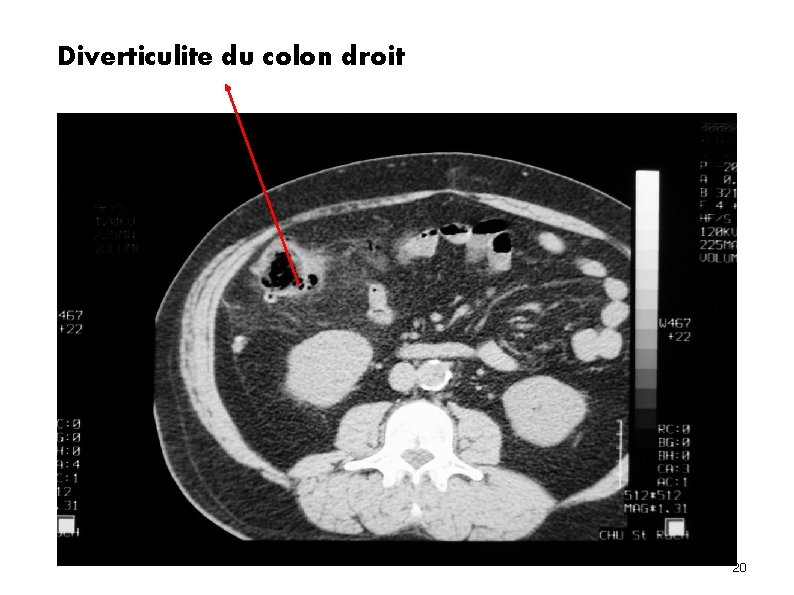 Diverticulite du colon droit 20 