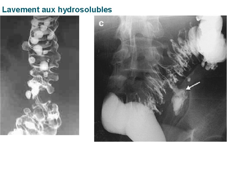 Lavement aux hydrosolubles 