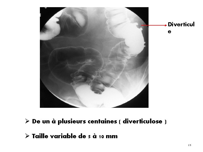 Diverticul e De un à plusieurs centaines ( diverticulose ) Taille variable de 5 Diverticul e De un à plusieurs centaines ( diverticulose ) Taille variable de 5