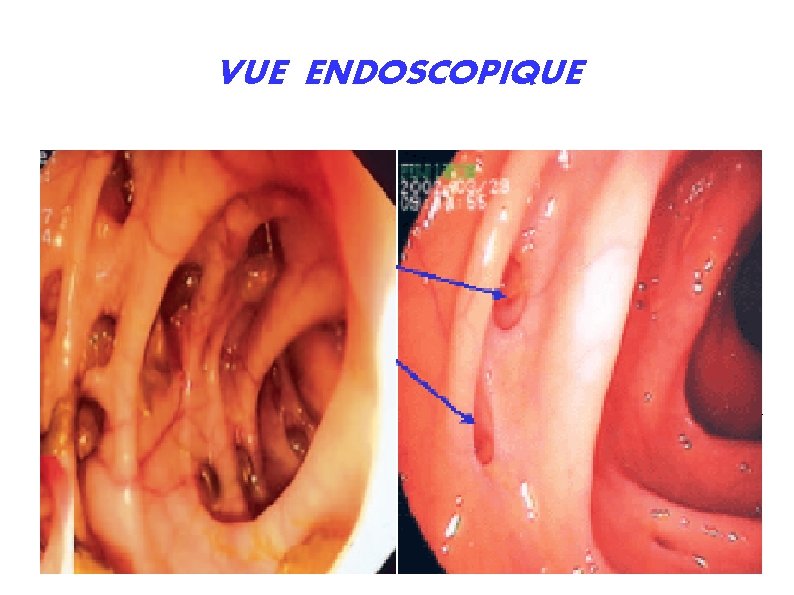 VUE ENDOSCOPIQUE 25 