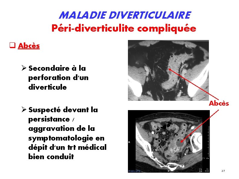 MALADIE DIVERTICULAIRE Péri-diverticulite compliquée Abcès Secondaire à la perforation d'un diverticule Suspecté devant la MALADIE DIVERTICULAIRE Péri-diverticulite compliquée Abcès Secondaire à la perforation d'un diverticule Suspecté devant la