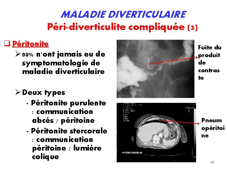 MALADIE DIVERTICULAIRE Péri-diverticulite compliquée (3) Péritonite 80% n'ont jamais eu de symptomatologie de maladie